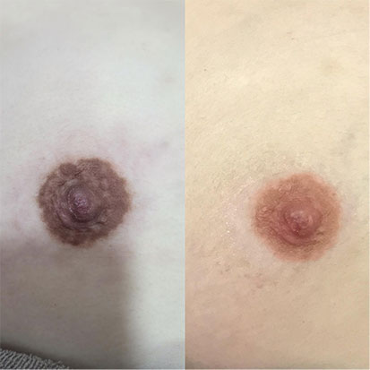 Before x Tone by Before & After Aesthetics Nipple