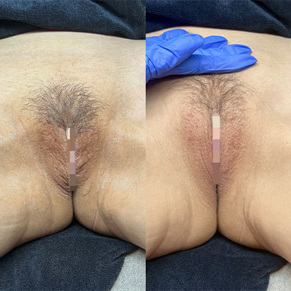 Before x Tone by Before & After Aesthetics Nipple