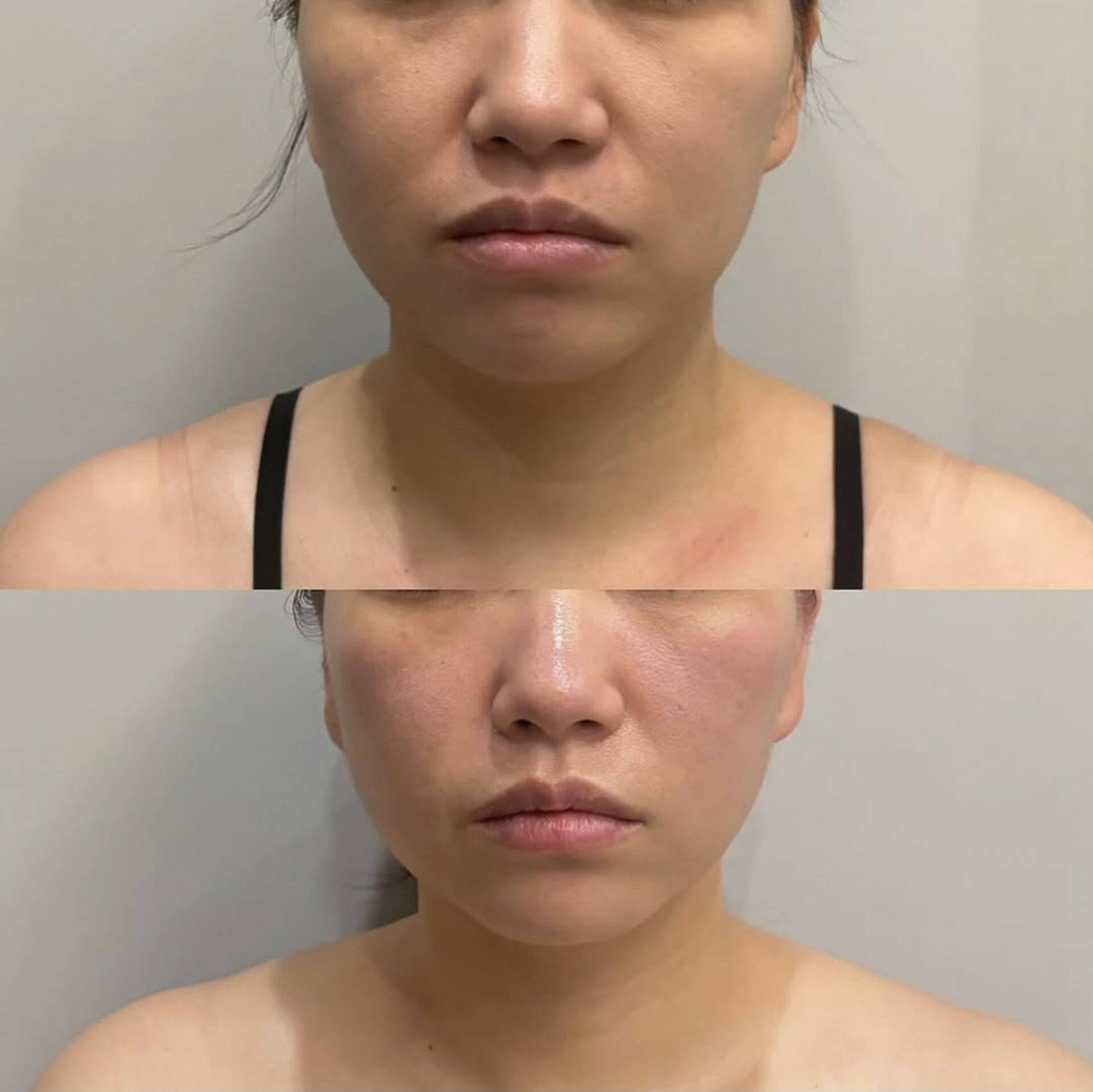 If your face looks tired or less defined, Before x Lift™ delivers visible lifting and sharper contours — without surgery or downtime.