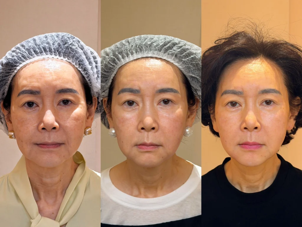 K1-Jet Before & After Treatment Results