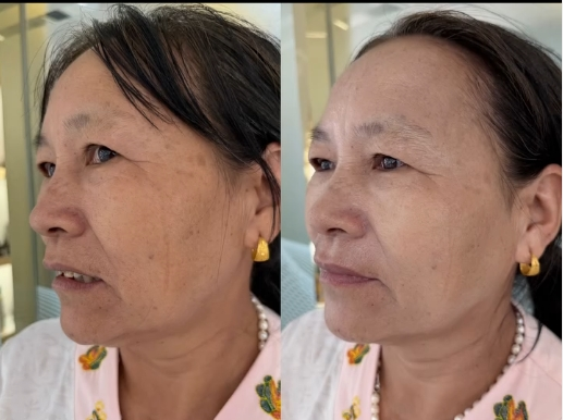 Before and after complexion brightness, BAEK™ skin brightening treatment