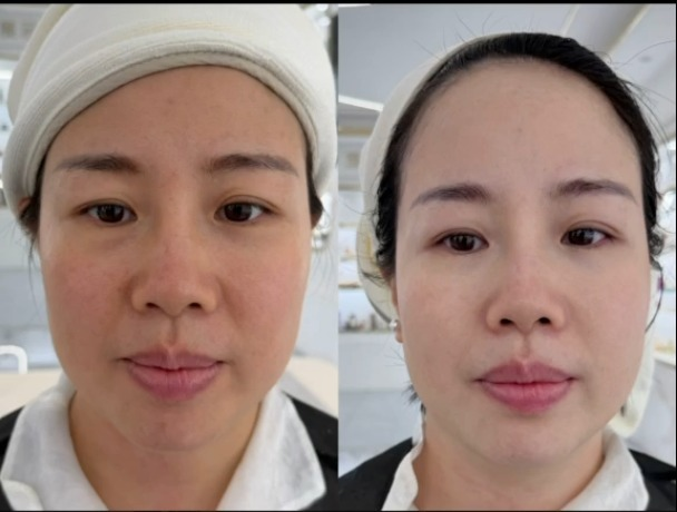 Before and after complexion brightness, BAEK™ skin brightening treatment